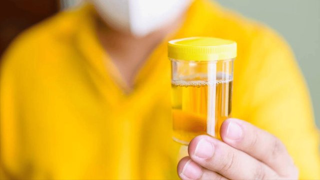 北京协和分析376名肾衰竭病人	，惊讶发现：他们几乎都有这9个共性