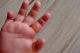 烫伤后30分钟很重要！孩子烧伤、烫伤后很多家长第一步就做错了图片