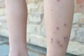 没看见被虫咬，咋会是虫咬皮炎？图片