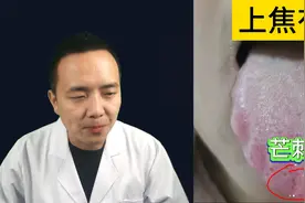这个舌头舌尖芒刺多，心肺火气太旺了！一起看看调理方法。图片