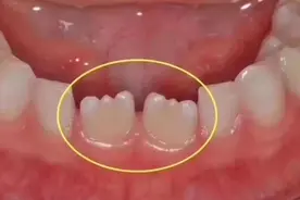 孩子牙齿呈不规则形状？竟是梅毒牙？别让自己的无知害了下一代图片