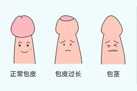 这样做包皮手术，必须给佑佑点个赞！图片