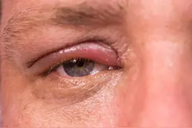 孩子频繁眨眼只是眼疲劳吗？图片
