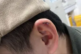 缝了六针！小伙理发时耳朵被剪掉一块肉图片