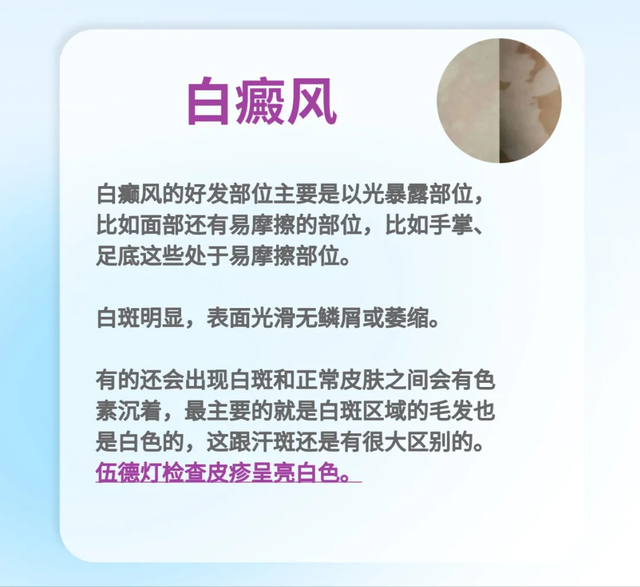 白癜风与汗斑如何分辨？3 大差异 + 自测法，一文搞懂