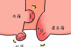 为啥你的痔疮了？教你6个应对方法，必要时选择手术治疗！图片