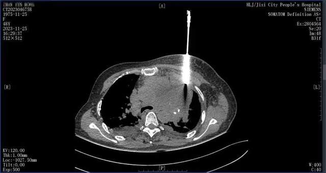 肺部积水治疗方法 2f81a64dd888407285901d34872d8a0c~tplv-tt-shrink:640:0.jpg?lk3s=06827d14&traceid=202312060903450EB14C5F04D3631EF937&x-expires=2147483647&x-signature=NgVlouU6MPzRkfumokcLkNlETig%3D