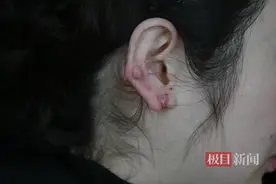 女子长年戴耳环不摘，双耳竟结“葡萄”图片