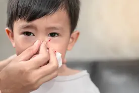 鼻衄 | 病症概览图片