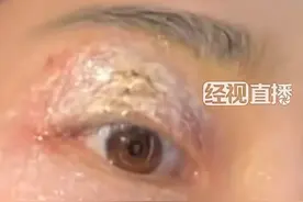 千万不能拍！这种“飞行硫酸”有剧毒！有人中招后眼皮开始溃烂图片