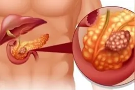 全球首例，中国研发！治疗癌新突破！苏州打一针遏制“癌王”！图片