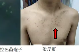 少年前胸后背冒出“青春痘”？原是天热运动后引发易长疤的毛囊炎图片