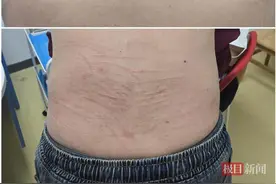 被香菇“打”了？男子一觉醒来身上遍布“鞭痕”，医生提醒：这些食物一定要煮熟图片