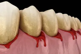 牙龈出血是缺少维生素C，这是真的吗？图片