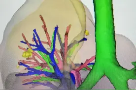 肺癌真相快问快答（九）：多发磨玻璃结节安全可控但需合理随访图片