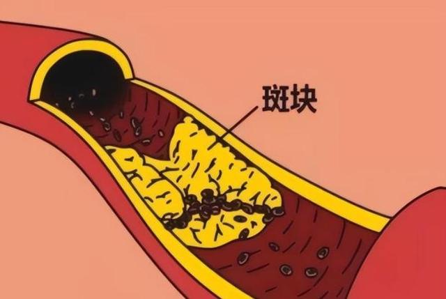 浙大研究：爱跑步的人，患心脑梗的概率比不跑步的人高10倍不止？