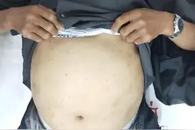 肝硬化患者如果出现这5种症状，真的不能再拖了！图片