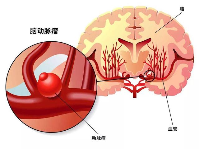 常头疼，一定是脑梗吗？警惕这5种疾病的伪装，别大意
