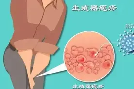 远离生殖器疱疹：识别症状，阻断传播，科学防治图片