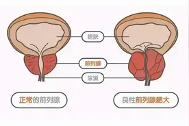 前列腺增生不用怕，这五种首选药物高效还安全图片