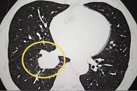 肺癌术后复查，发现肺部小结节，是不是复发转移了？图片