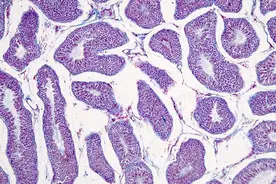 浸润性癌一般能活几年？出现这2个情况，5年生存率可提升80%！图片