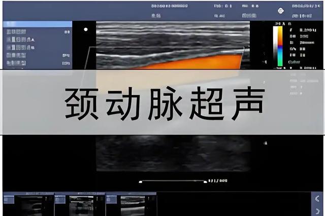 颈动脉狭窄,头脑先知,注意5种症状,或是颈动脉斑块的早期信号