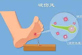 回顾：52岁大哥踩到铁钉，打了两针破伤风，半年后身体咋样？图片