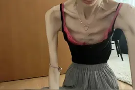 女子减肥不要命，从120斤减到31斤，每天只吃三勺饭，瘦成骷髅图片