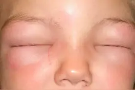 眼睑肿、四肢肿、全身肿，教你几个小方，轻松化解，请勿因小失大图片