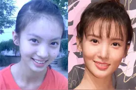 整容有风险，爱美需谨慎！这些整容后遗症你能接受吗？图片