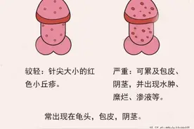 男性龟头总是又痛又痒，还长“小红疙瘩”，小心是龟头炎！图片