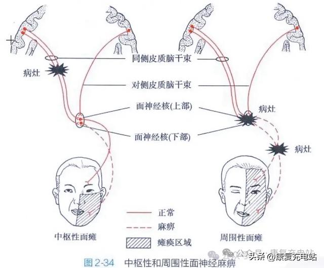 中枢性面瘫和周围性面瘫区分思路