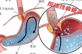 我是如何缓解反流性食管炎症状的图片