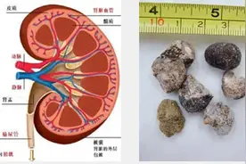 视频曝光！男子得肾结石痛不欲生，这痛苦让人心疼！图片
