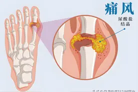 大脚趾痛就是痛风吗？怎么判断？还要小心哪些疾病？图片