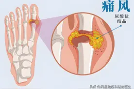大脚趾痛就是痛风吗？怎么判断？还要小心哪些疾病？图片