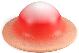 屁股长了个硬疙瘩一碰就疼，可能是这5个原因，医生：不懂别乱挤图片