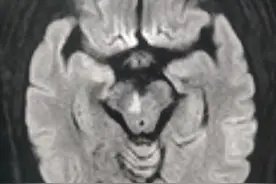 Claude综合征图片