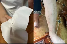 重庆一小区流浪猫死亡致跳蚤成灾！消杀无果，有孩子被咬满腿疙瘩！图片