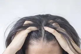 脱发的治疗：有效的口服药选择，有两个，医生帮你出主意图片