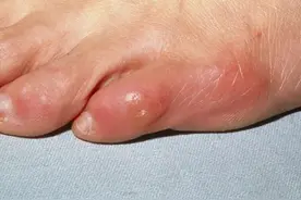 鸡眼是扎刺还是病毒？去鸡眼真要在脚底挖洞吗？听医生讲图片