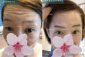 肉毒素多久注射一次？注射在哪些部位？有耐药性吗？有副作用吗？图片