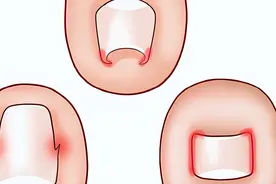 脚趾甲总往肉里钻，一碰还疼？再也不想经历了！4招可预防！图片