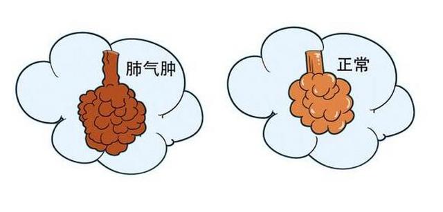 医生提醒：肺结节随访复查的5个黄金时间点，错过可能误大事