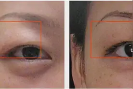 早晨水肿，脸像胖了20斤？这些原因可能导致你早晨浮肿图片