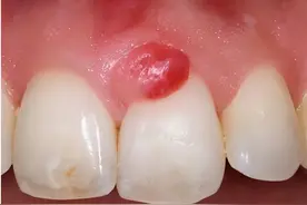 牙龈出现脓包，为什么？图片