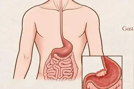 医生警告：一旦得了胃炎，不想恶化癌变，这几事快停下，别害自己图片