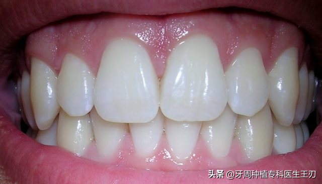 牙龈增生的原因和治疗方法