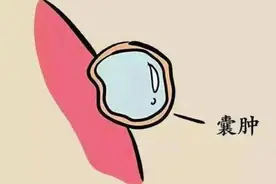 一个专方，堪称洗涤剂，清全身痰瘀，通一身气血，破开囊肿图片